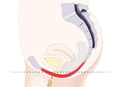 Pelvic-Floor Muscle Repair 5 Pelvic floor muscles Walthams Cross