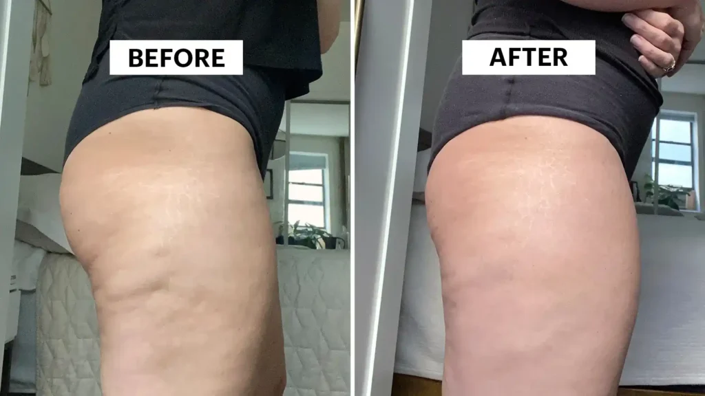 Sculpting Your Bum: Can Toning Exercises Really Reduce Cellulite? 1 Do Toning Exercise Walthams Cross Really Tackle Cellulite?