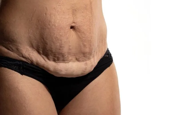 The Science of Skin Tightening 1 The science behind skin tightening Walthams Cross picture of a woman's sagging skin on the stomach
